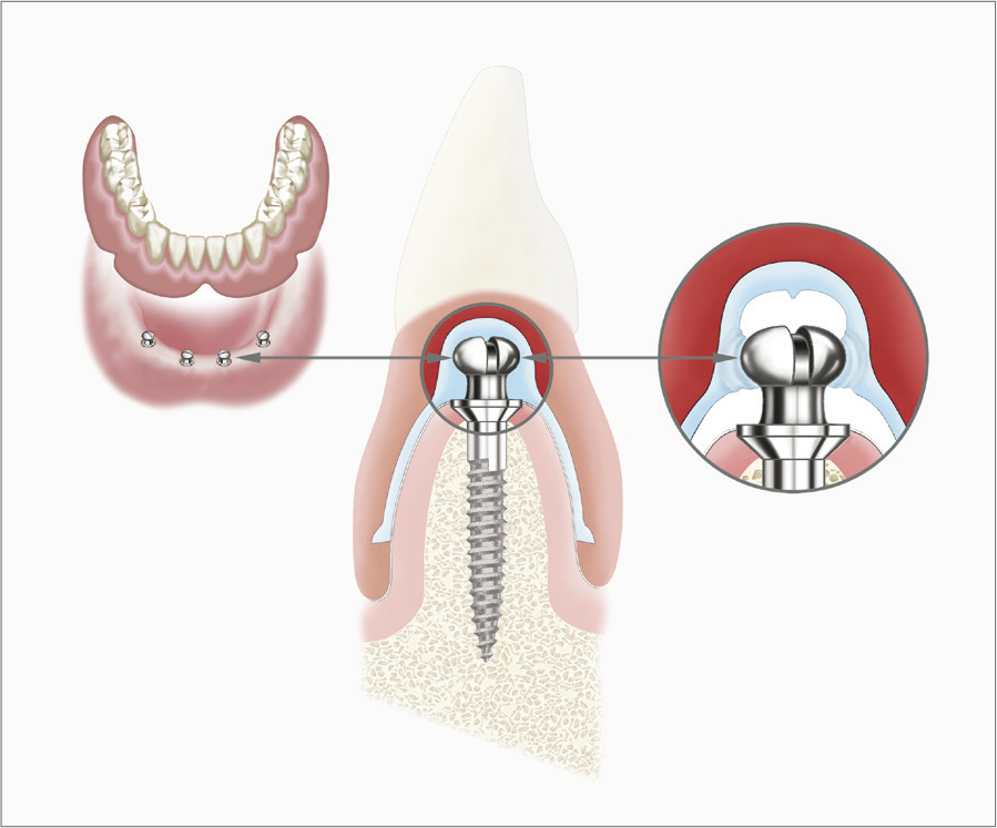 Implant étroit ATLAS Dentatus